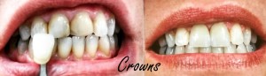 crowns1